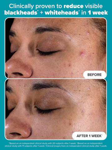 Paula's Choice Skincare 2% BHA Liquid Exfoliant