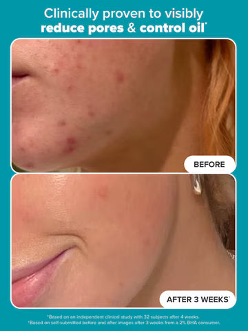 Paula's Choice Skincare 2% BHA Liquid Exfoliant